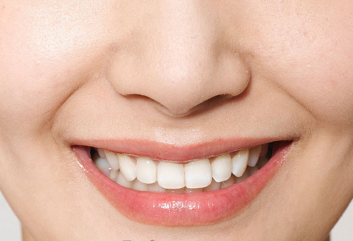 怎麼認識牙齒移位?