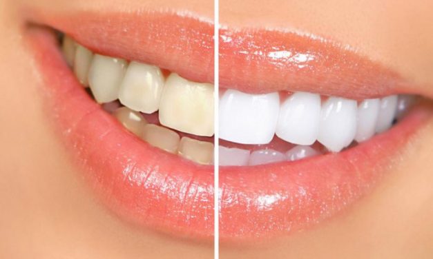 牙齒美白的方式及效果