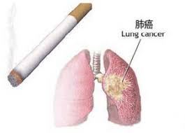 肺癌瞄準抽煙人士
