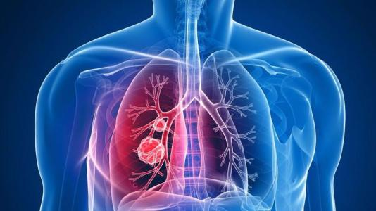 肺部发现结节是肺癌吗？