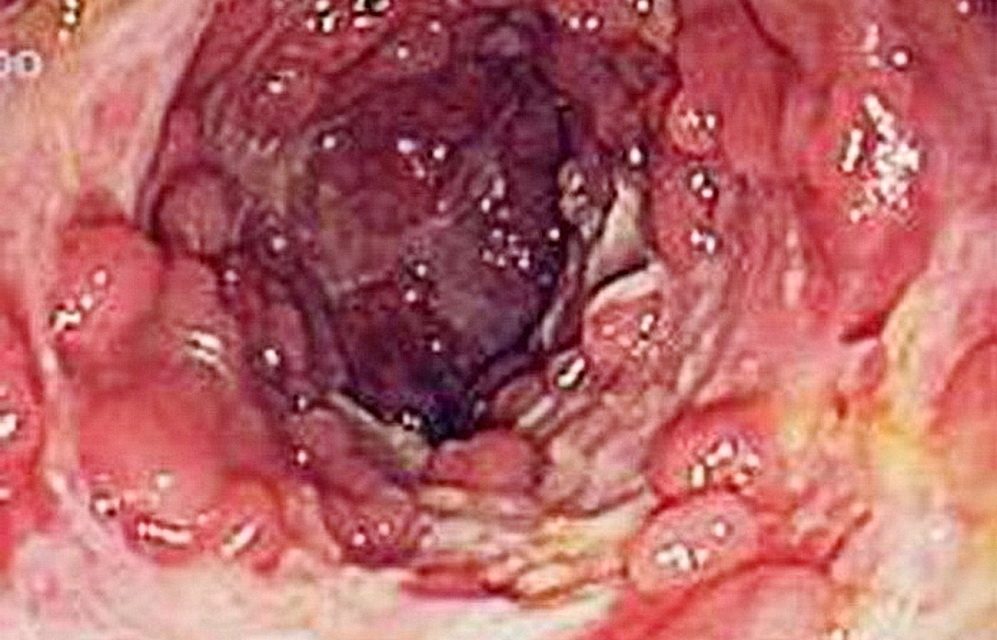 教你分辨大腸癌症狀