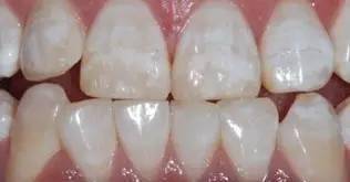 牙齒白斑和脫鈣