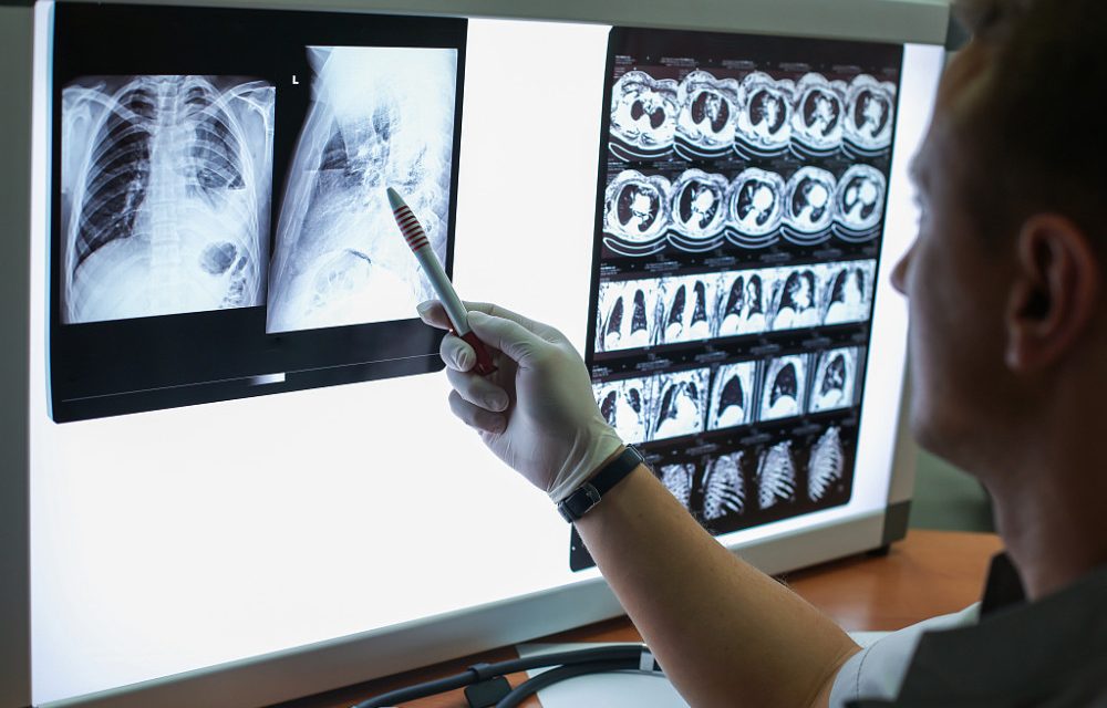 如何看CT上的肺结节？