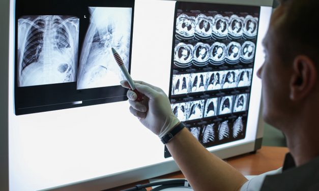 如何看CT上的肺結節？