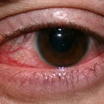 角膜炎：嚴重的致盲性眼病