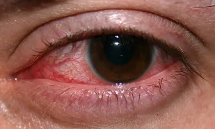 角膜炎：嚴重的致盲性眼病