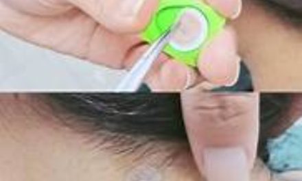 “無痛” 針灸──撳針