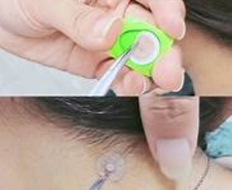 “無痛” 針灸──撳針