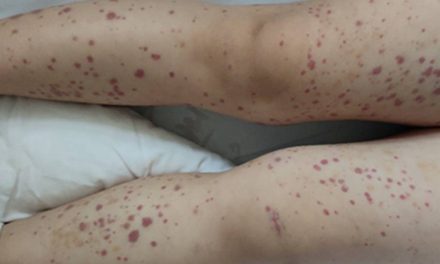 中醫調養小兒過敏性紫癜