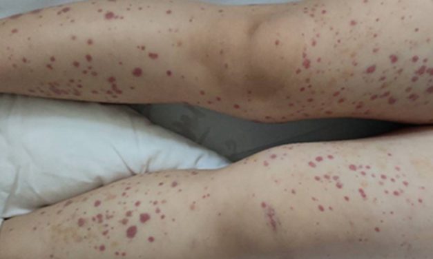 中醫調養小兒過敏性紫癜