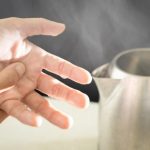 燒燙傷急救，你做對了嗎？