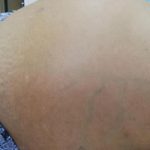 肝硬化八大併發症