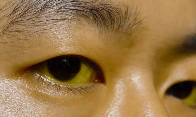 胰腺癌為什麼難以發現？